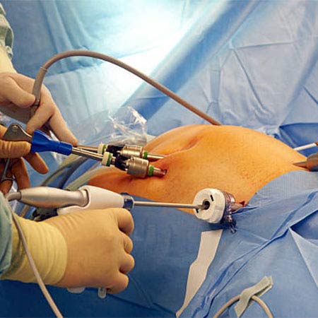 laparoscopy surgery in Vijayawada