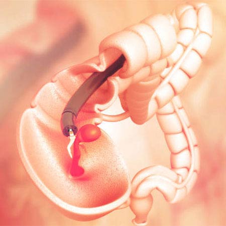 colonoscopy